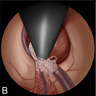 B：用双极电凝脉络丛。