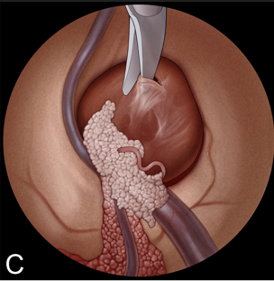C：用剪刀切开囊肿包膜。