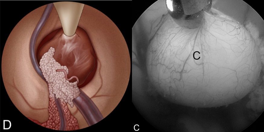 D：用吸引管吸出囊肿内容物，像一颗剥壳荔枝。(右侧为真实术中场景)。
