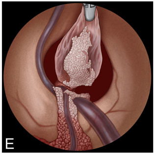 E：将囊肿移入侧脑室。