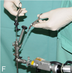 F：采用双手手术技术暴露囊肿蒂。通过左侧通道插入一把可弯曲的抓钳。主要手术器械通过 2.9 毫米的直工作通道引入。