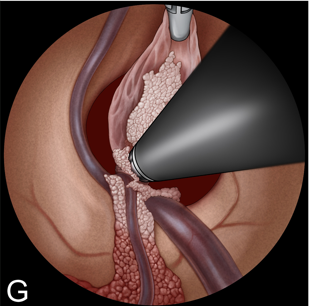 G：用双极电凝器采用双手手术技术凝固囊肿蒂。