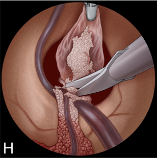 H：用剪刀采用双手手术技术切断囊肿蒂。