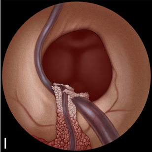 I：囊肿切除后检查室间孔。