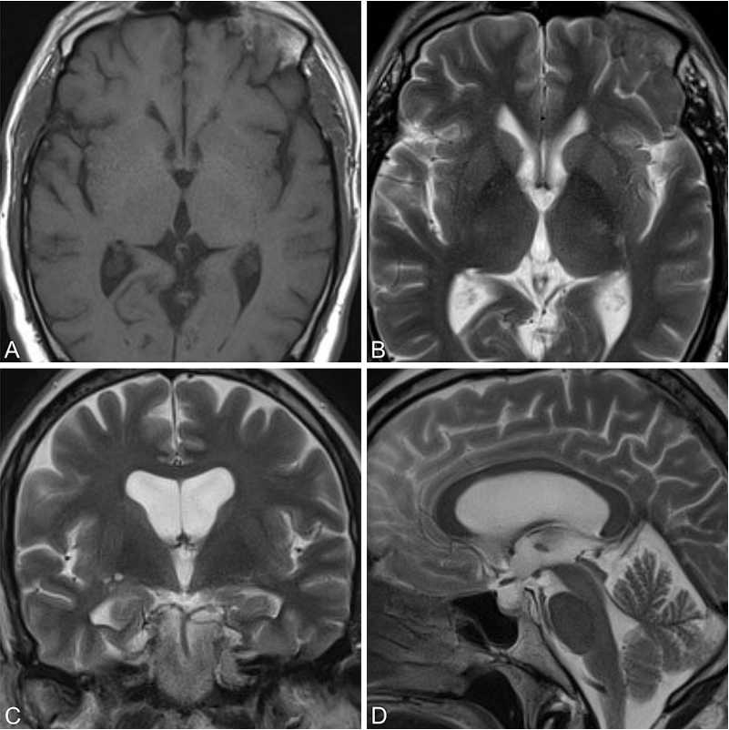 术后3年获取的 T1 加权(A 为轴位)和 T2 加权(B 为轴位;C 为冠状位;D 为矢状位)磁共振图像显示无囊肿复发。
