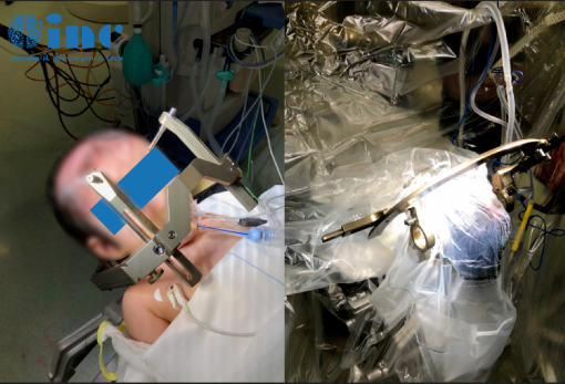 最终利利的脑瘤得到了极大程度的消融