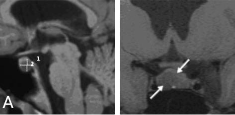 核磁共振成像显示垂体窝中有一个小肿瘤，将正常垂体向左侧移位