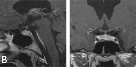 术后核磁共振成像显示肿瘤已完全切除。泌乳素水平趋于正常。垂体正常工作，无需补充激素。