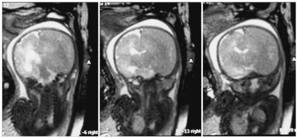 图1:孕31周胎儿MR图像显示,右侧大脑半球有一个巨大的颅内脑血肿移位。右侧脑室向对侧移位,左侧脑室轻度增大。