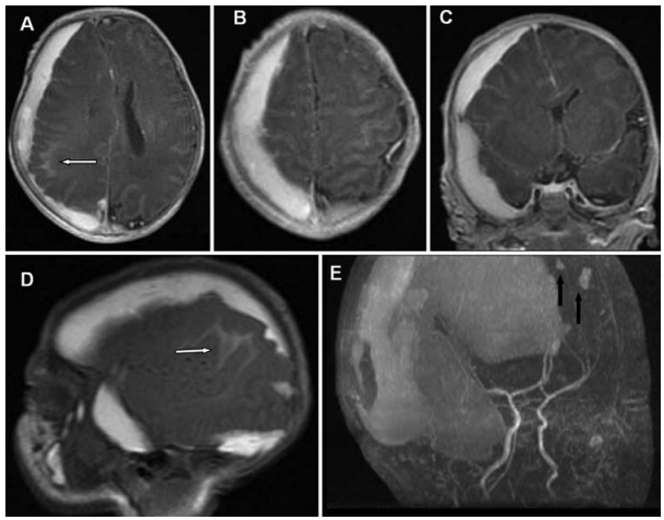 图2:新生儿(出生后第1周)脑部T1加权轴向(A和B)、冠状(C)和矢状(D)磁共振图像,以及3D血管造影磁共振图像(E),确认右侧脑血肿(厚度15 mm)的存在,导致质量效应,随后中线移位4.4 mm,右侧脑室受压。注意顶叶SAH(白色箭头)和额叶挫伤(黑色箭头)