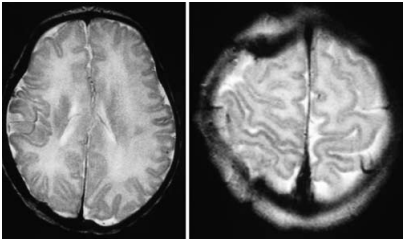 图3:术后1个月复查MR检查,提示半球硬膜下出血、额叶挫伤治疗后的正常变化。