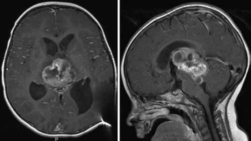 第三次减瘤手术前，肿瘤的囊性成分显著增加，导致脑干受压，促使再次手术。