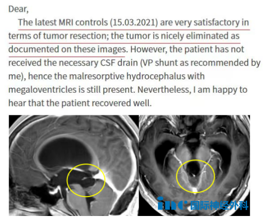 术后3个月，小永的复查MRI显示肿瘤已经很好地切除了。由于术前伴有长期的梗阻性脑积水，导致脑室扩大，脑积水吸收不良仍然存在，还需要一段时间的康复治疗。但他的整体状态已经恢复得很好了，可以逐步回归正常的生活。巴教授对此感到十分高兴。