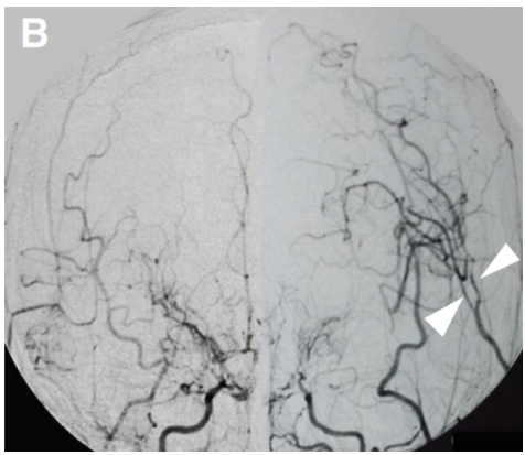 术后Xe-CT显示左侧大脑中动脉区域明显血流灌注(局部脑血流量:26.8 ml/100 g/min)，血管通畅。