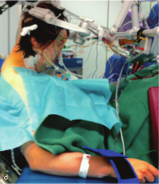 正常脑组织完好无损，而肿瘤被成功切除。