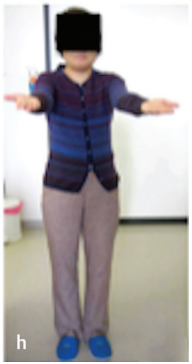 术后11年随访，肿瘤无复发。术后享受着正常人的生活。