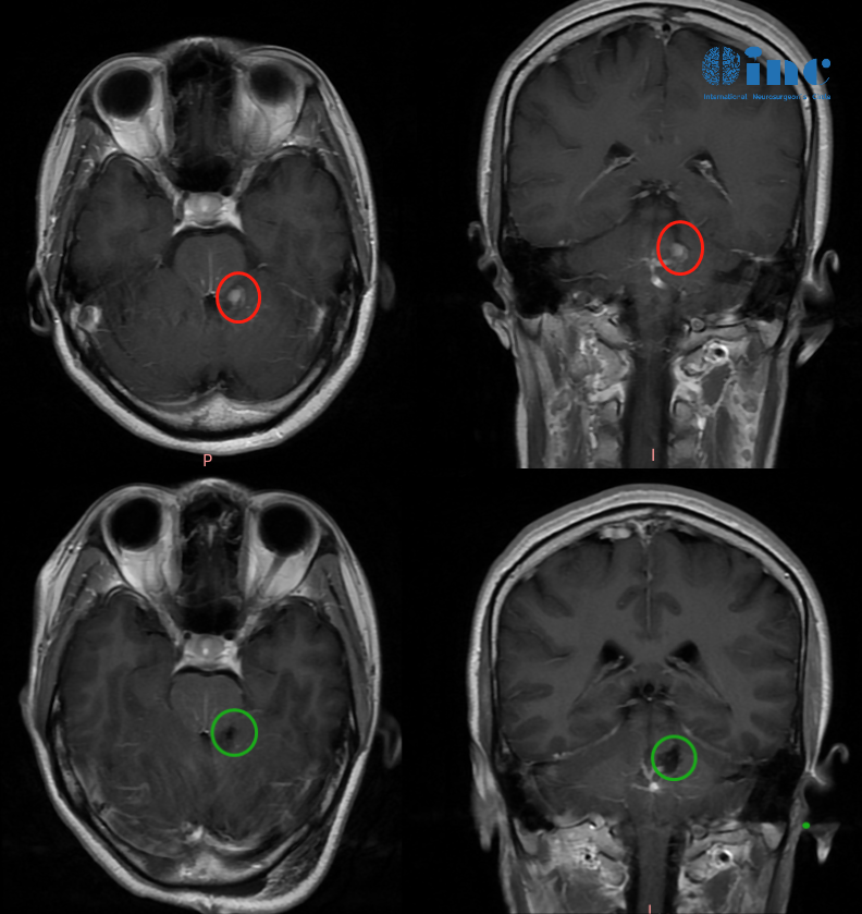 晓玲术前术后影像对比
