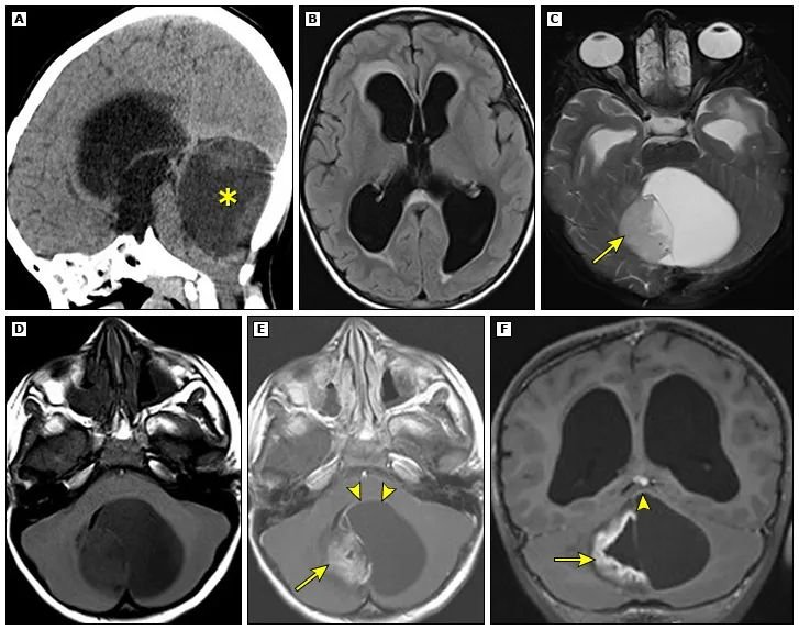 一名 5 岁儿童患有毛细胞星形细胞瘤，因梗阻性脑积水就诊。矢状位平扫 CT (A) 显示大的低密度小脑肿块 (*)，该肿块压迫脑干并导致第三脑室和侧脑室扩大。横轴 FLAIR (B) MRI 显示经室管膜水肿，提示急性脑积水。横轴 T2- (C)、T1- (D) 以及横轴 (E) 和冠状 (F) 平面中的对比后 T1 加权图像显示带有壁结节的囊性小脑肿块（箭头）。壁结节内以及囊肿壁的一部分（箭头）内存在增强。