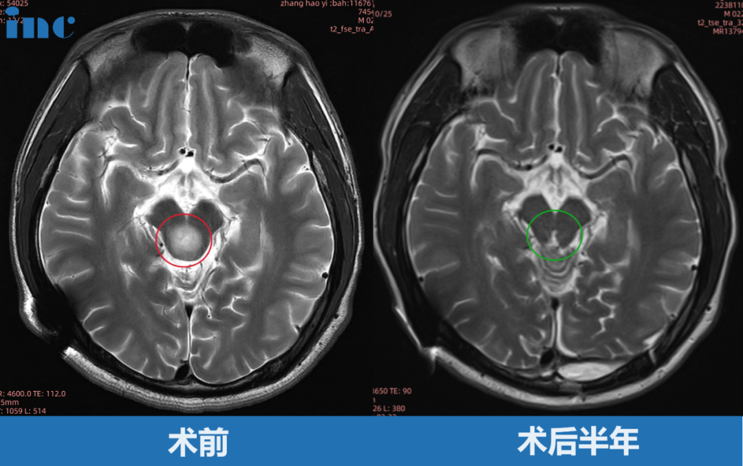 小远因突然出现的剧烈头痛伴呕吐症状，于当地医院就医检查，提示中脑顶盖占位性病变，最大直径约8mm，随后一年磁共振复查无变化。2年会复查磁共振提示肿瘤增大，最大直径 12mm。2月后复查核磁再次提示肿瘤增大，自行测量肿瘤大小约 18mm，两月内竟激增6mm！经巴教授主刀后，肿瘤全切。