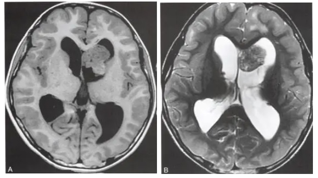 室管膜下巨细胞星形细胞瘤