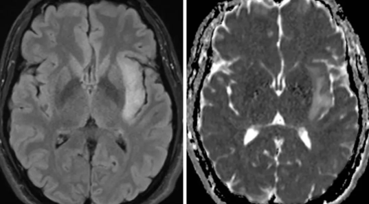 一般增强后扫描多为不规则环状强化，少数为结节状、斑片状强化。
