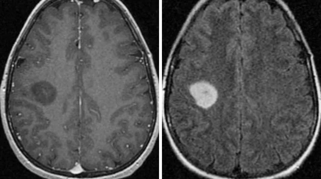 MR平扫可见边界模糊异常信号灶，少部分边界清晰者可见类圆形肿块影，T1WI序列可见等/低信号，T2WI序列可见高信号，病灶内信号不均匀，可伴囊变信号影，病变周围少有水肿，占位效应轻；增强扫描后病灶强化不明显，或仅可见轻中度强度表现，以小片状、环状及结节状强化多见，伴囊变患者多可见非规则环形强化。
