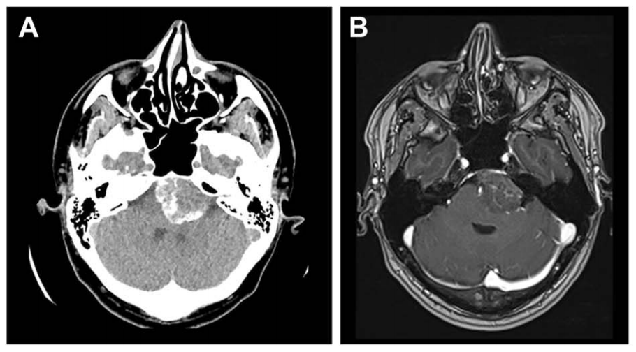 诺亚术前影像，左侧岩斜区脑膜瘤，呈不均匀强化。