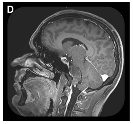 矢状位 MRI 显示肿瘤经栓塞后血供部分阻断(部分去血管化)。