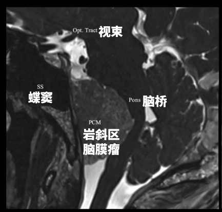 手术难点2：肿瘤位置深在，与神经、血管粘连严重