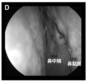 术后 4 周内镜复查显示鼻黏膜缝合处愈合良好，无结痂，患者无鼻部不适主诉。
