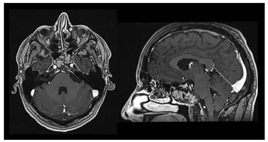 术后 2 个月 MRI 轴位及矢状位示：脑膜瘤已完全切除，脑干复位良好。