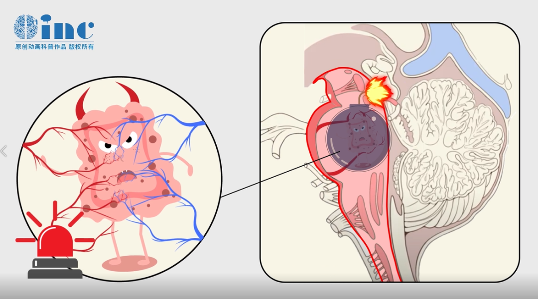 中脑及桥脑右侧占位海绵状血管瘤继发出血