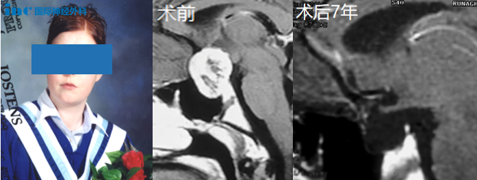 “脑瘤再狂又能怎？”颅咽管瘤折磨她5年，勇敢切瘤后7年未复发、顺利毕业！