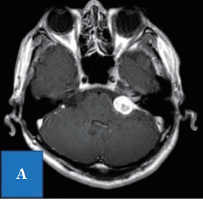 入院时T1-加权项磁共振成像显示，延伸到内听道的桥脑角均匀增强