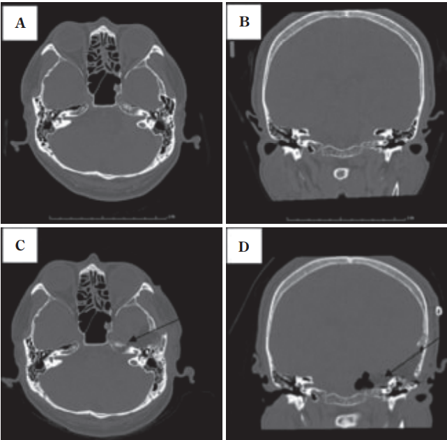 A&B：术前轴向和冠状面计算机断层扫描图像，显示岩骨水平的内听道。一个巨大的高颈静脉球延伸到后颅窝;C&D：术后图像显示切除的内耳道前壁和上壁。