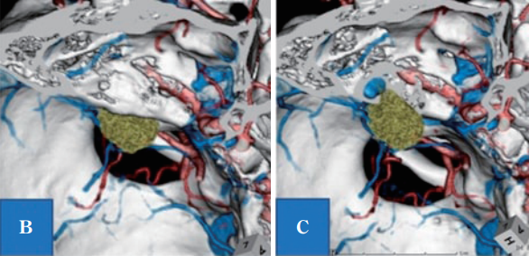 B：计算机断层扫描-骨骼血管造影(CTA)显示，左上前侧有肿瘤(绿色肿块是增强区域);C：B所示的IAC壁骨缺失，显示颈高球非常靠近内听道和肿瘤。