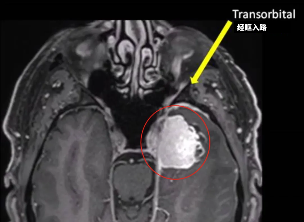 即从眉弓切除这个肿瘤。该入路可提供更好的手术视野和足够的操作空间，减少眼球的危险牵拉。