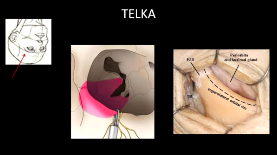 显微镜+神经内镜“双镜联合”手术，神经导航精准定位，“筷子技术”发挥优势。