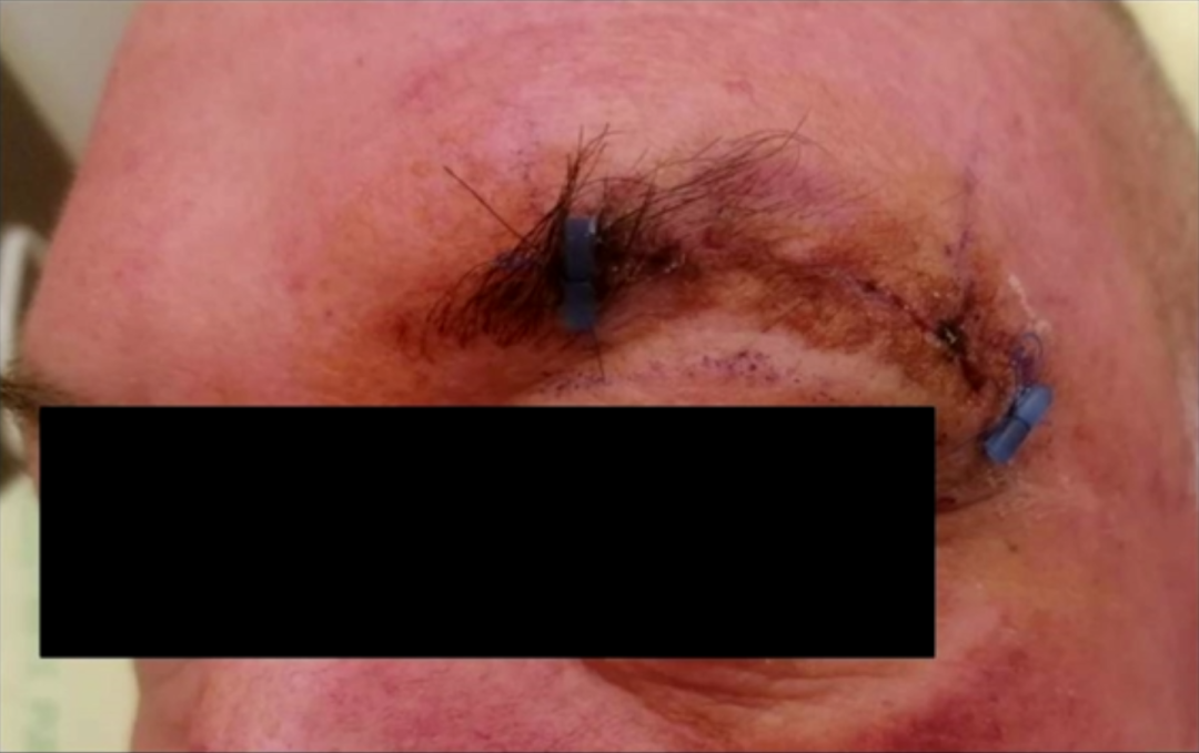 术后CT扫描显示肿瘤全切，无手术并发症。患者未出现任何神经功能缺损。术后第6天拆线出院。