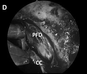 解剖、剥离并切除肿瘤包膜(D、E)