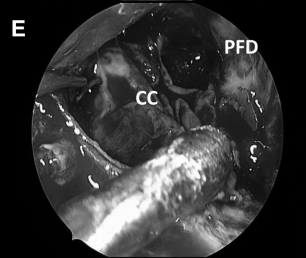 解剖、剥离并切除肿瘤包膜(D、E)