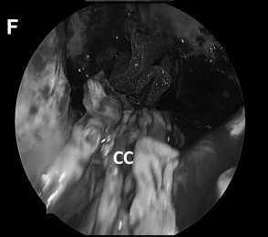 (F)可通过对侧入路通道、沿着肉芽肿病变长轴，利用吸引器和镊子，解剖分离病变包膜，达到次全切除病变的目的。