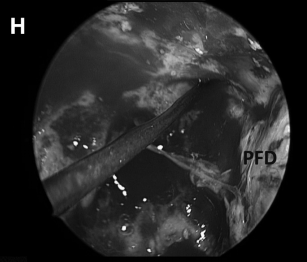 (H)术野侧面、后面方向为面神经所在。