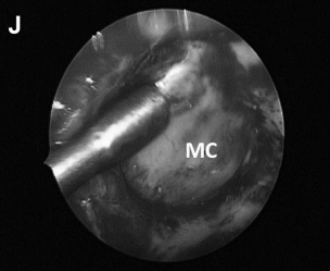 (J)使用 Endocameleon 内镜仔细检查术野、鼻道(IAC)