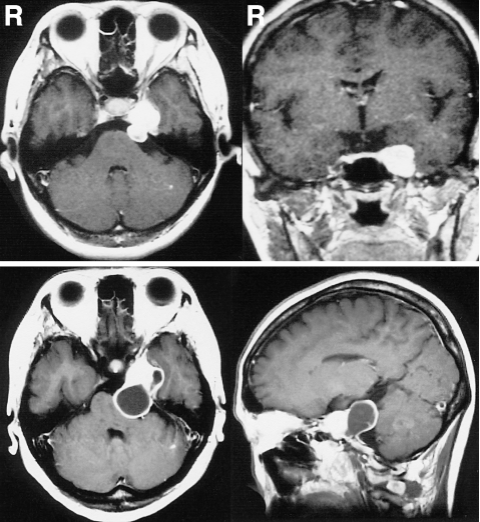 图1：(上排)伽玛刀放射治疗(GKR)前轴位和冠状位t1加权磁共振(MR)增强图显示左侧中窝和左侧后窝肿瘤，外观坚实，强化均匀。(下排)GKR术后18个月，轴位和矢状位t1加权钆成像显示肿瘤包含多个囊肿，并明显压迫脑干，囊肿后部周围有假囊，与后颅窝硬脑膜相连。