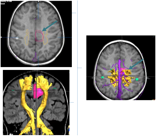通过MRI，特别是弥散张量成像（DTI），可以清楚地看到小洛脑袋中的致痫灶。