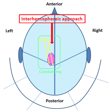选择合适的手术入路。