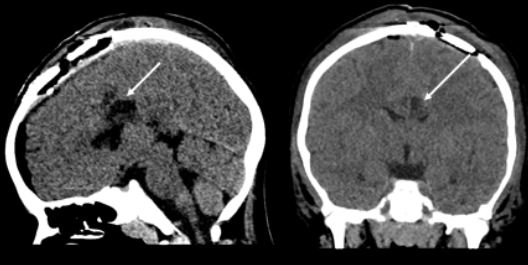 在细致的术中操作下，鲁特卡教授最终成功且安全地切除肿瘤。