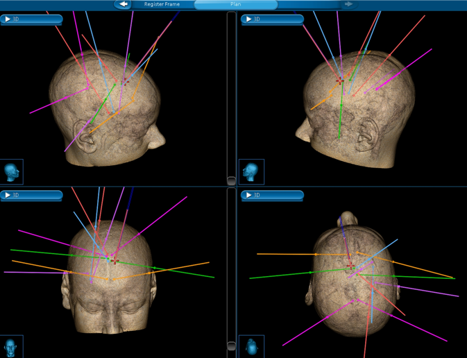这些患儿术后恢复迅速，通常在二天内出院，且智力和生长发育未受影响。