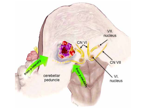 桥脑是脑干重要组成部分，是大脑下行神经纤维传导的通路，也是躯体感觉上行的传导通路。手术中一旦有失，极有可能伤及到神经功能。